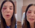 😱 IVETE SANGALO REVELA CIRURGIA: "Quebrei dois ossos"